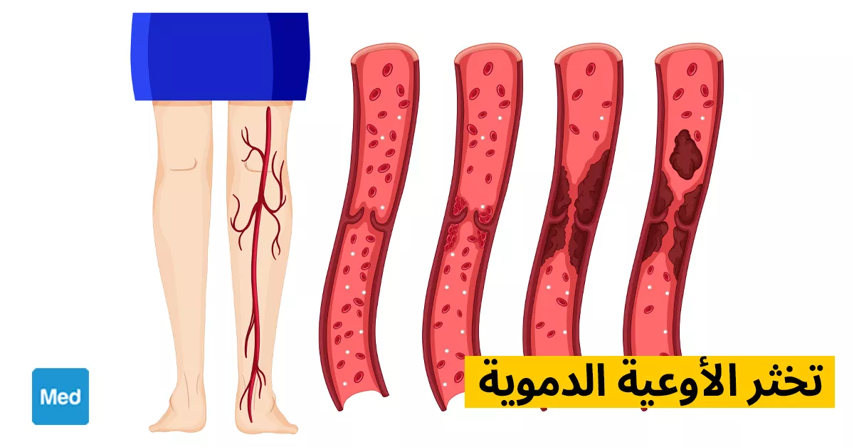 تخثر الأوعية الدموية